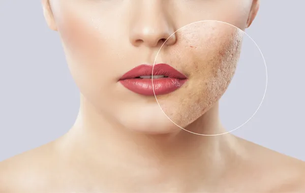 Tratamentul cicatricilor cu acid hialuronic