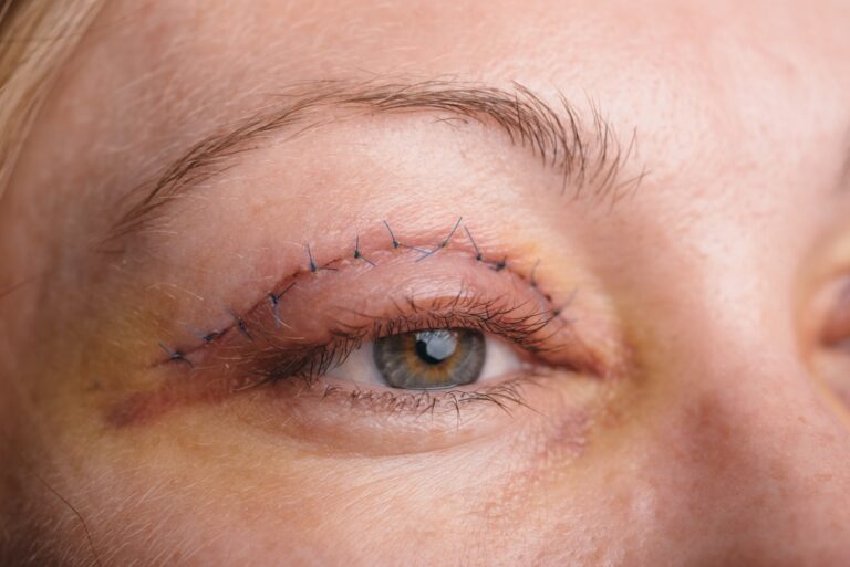 Totul despre blefaroplastia superioara