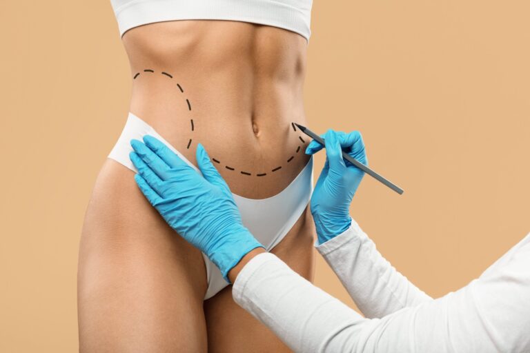 Abdominoplastie vs liposucție – Ghid complet pentru un abdomen plat și ferm