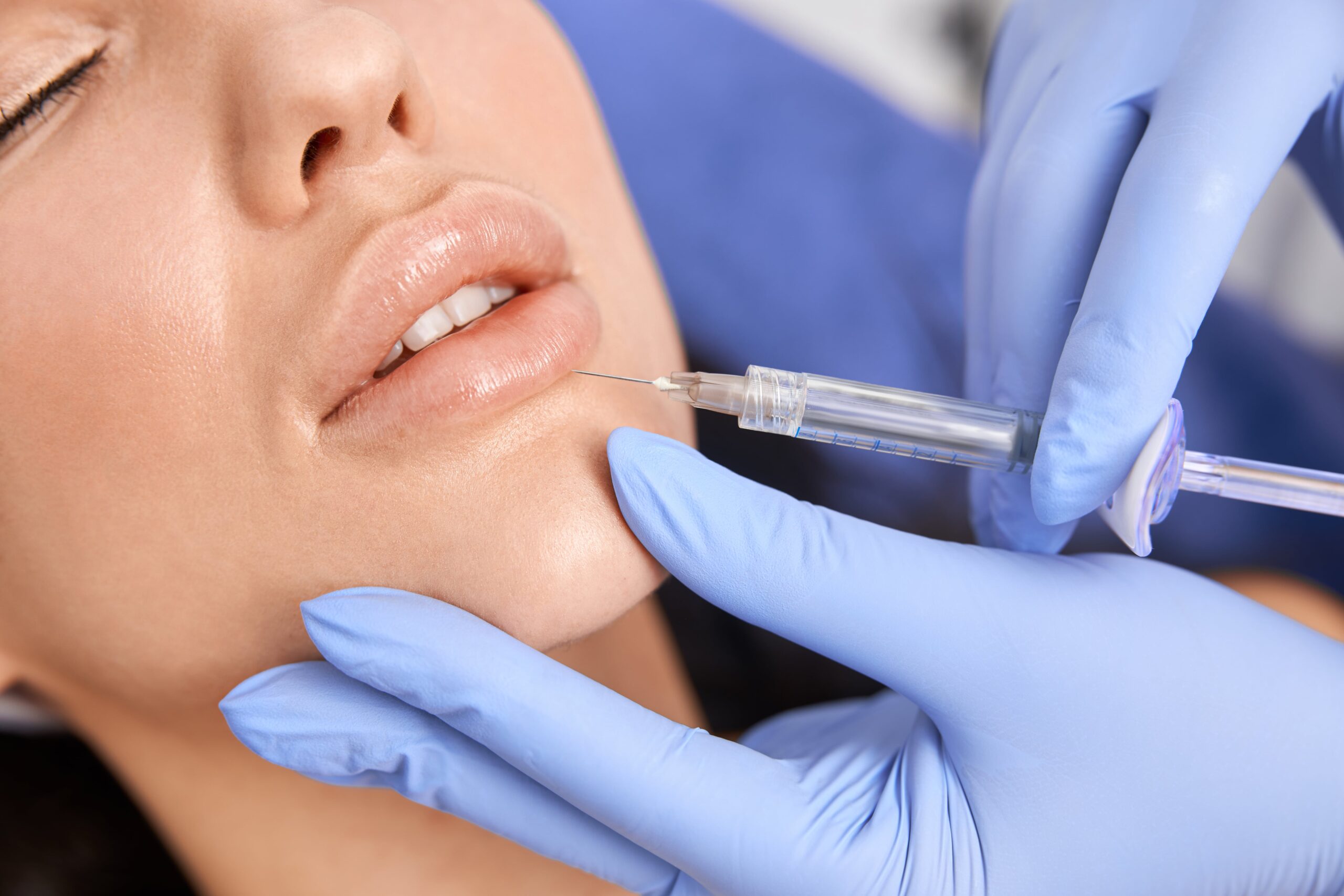 Conturarea buzelor cu acid hialuronic pentru formă delicată