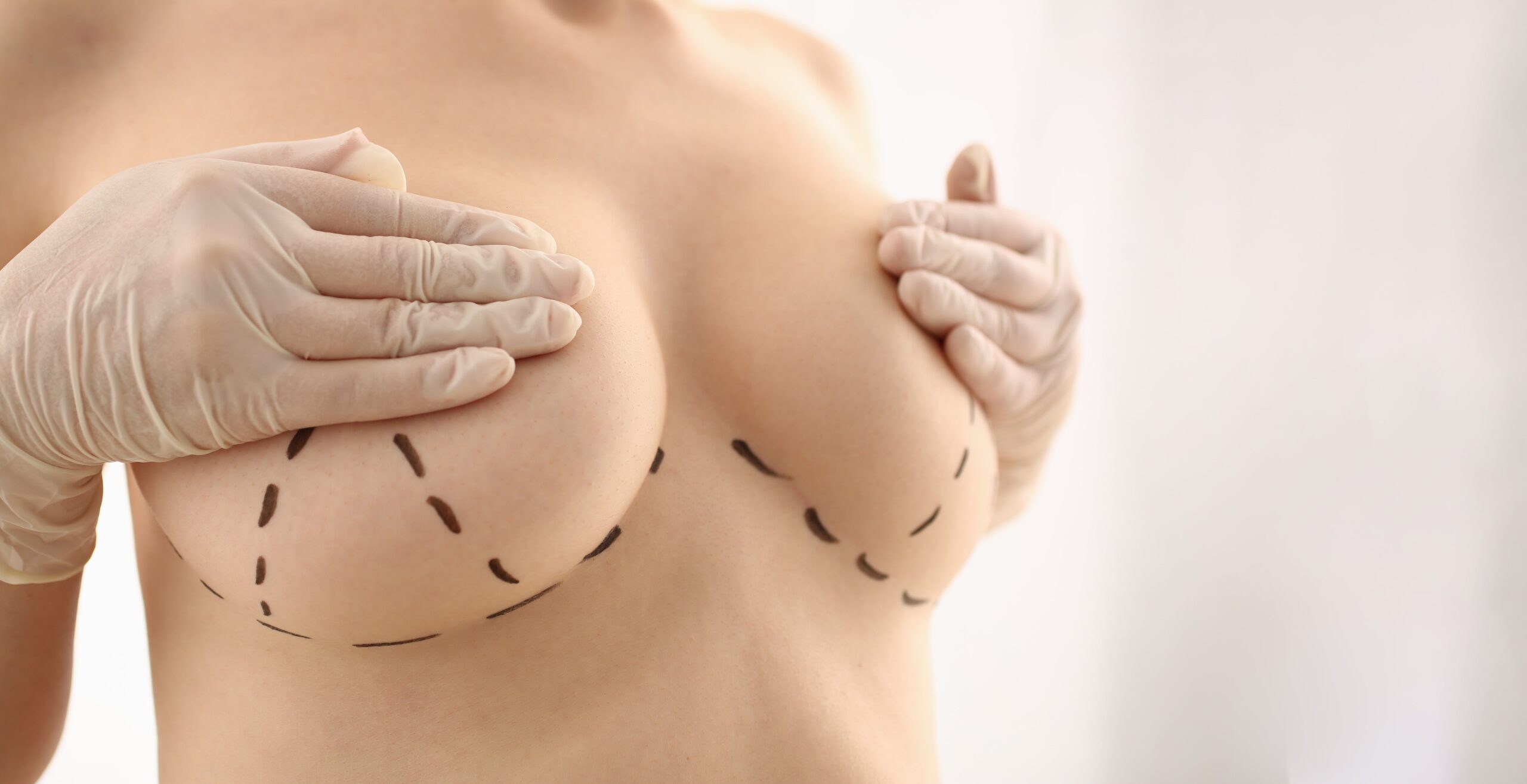 ingrijire cicatrici implant mamar Dr. Diana Gheorghiță București