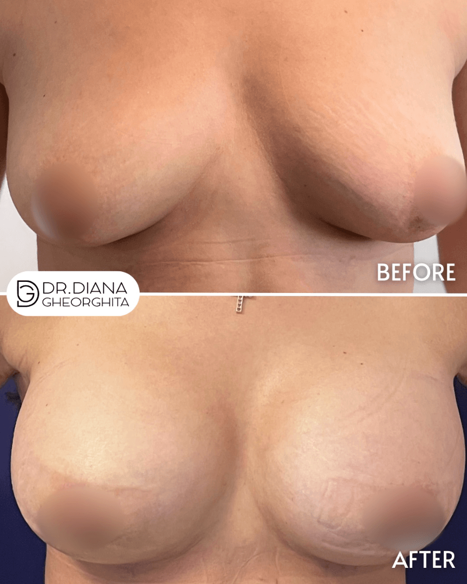 rezultate cicatrici implant mamar Dr. Diana Gheorghiță București