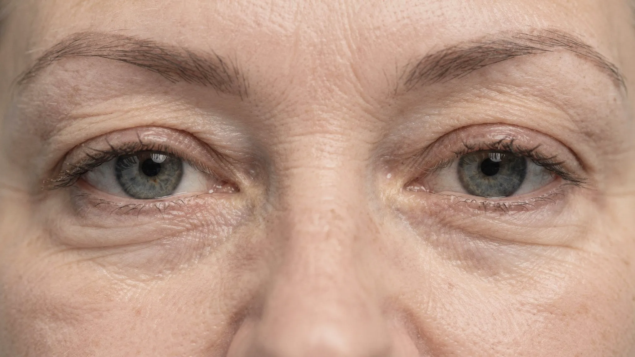 Blefaroplastie înainte și după: la ce să te aștepți - Main Image