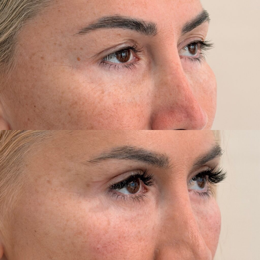 Blefaroplastie