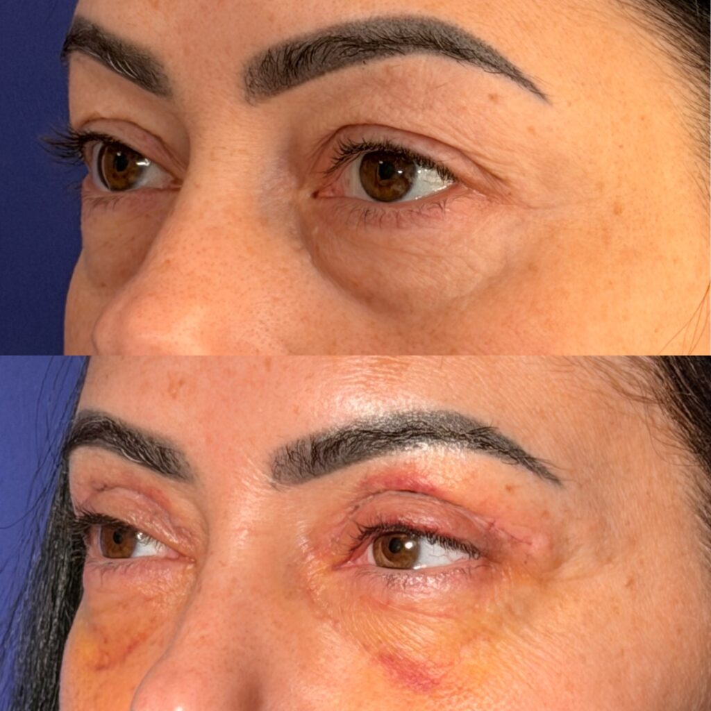 Blefaroplastie
