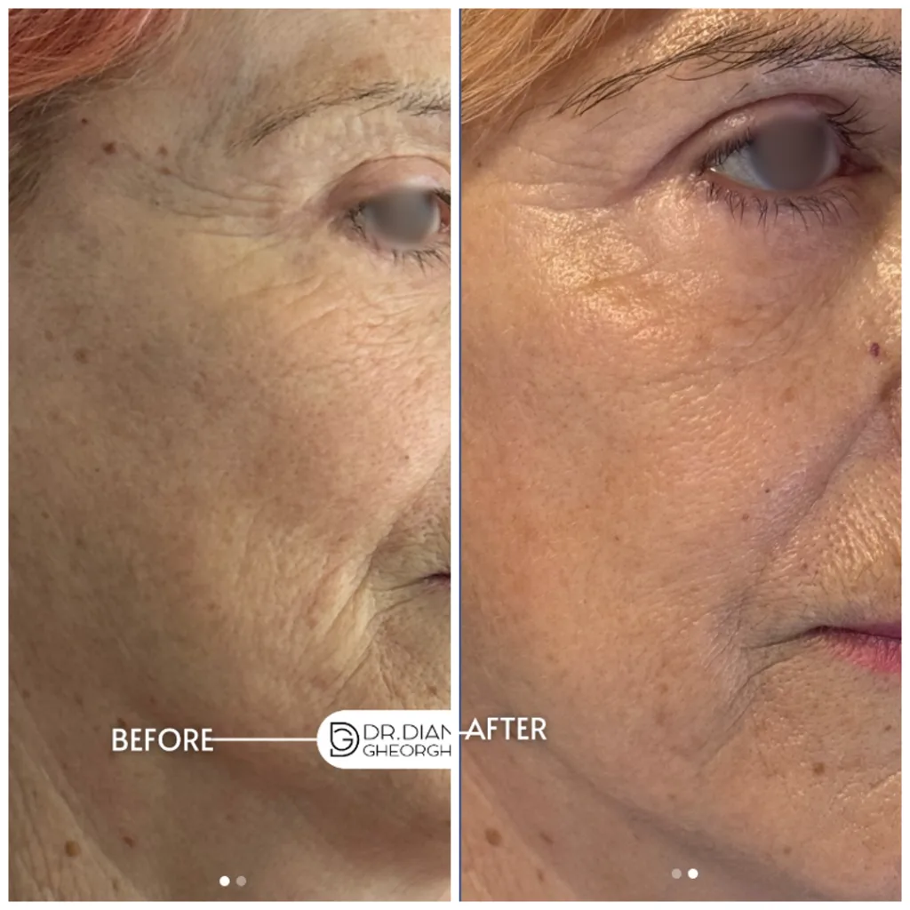 Rezultate lipofilling facial