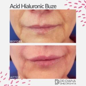 Rezultat mărire buze cu acid hialuronic — Dr. Diana Gheorghiță
