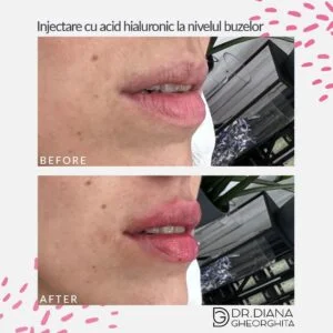 Rezultat mărire buze cu acid hialuronic — Dr. Diana Gheorghiță