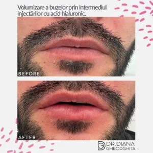 Rezultat mărire buze cu acid hialuronic — Dr. Diana Gheorghiță