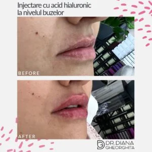 Rezultat mărire buze cu acid hialuronic — Dr. Diana Gheorghiță