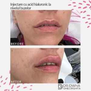 Rezultat mărire buze cu acid hialuronic — Dr. Diana Gheorghiță