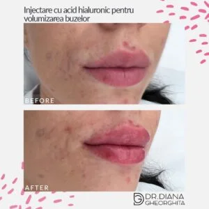 Rezultat mărire buze cu acid hialuronic — Dr. Diana Gheorghiță