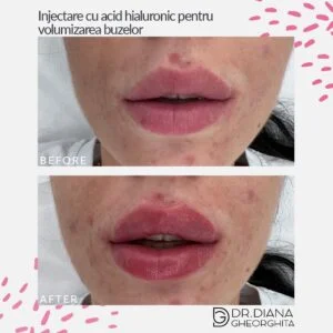 Rezultat mărire buze cu acid hialuronic — Dr. Diana Gheorghiță