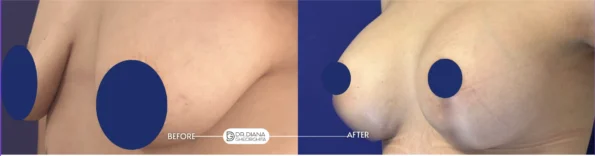 Implant mamar înainte și după