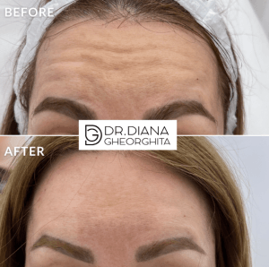 Rezultate tratament riduri cu acid hialuronic