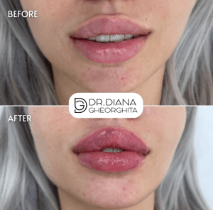 Mărire buze cu acid hialuronic