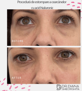 Rezultate estompare cearcăne cu acid hialuronic