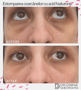 Rezultate estompare cearcăne cu acid hialuronic