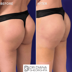 Rezultate mărire fese cu acid hialuronic — Dr. Diana Gheorghiță
