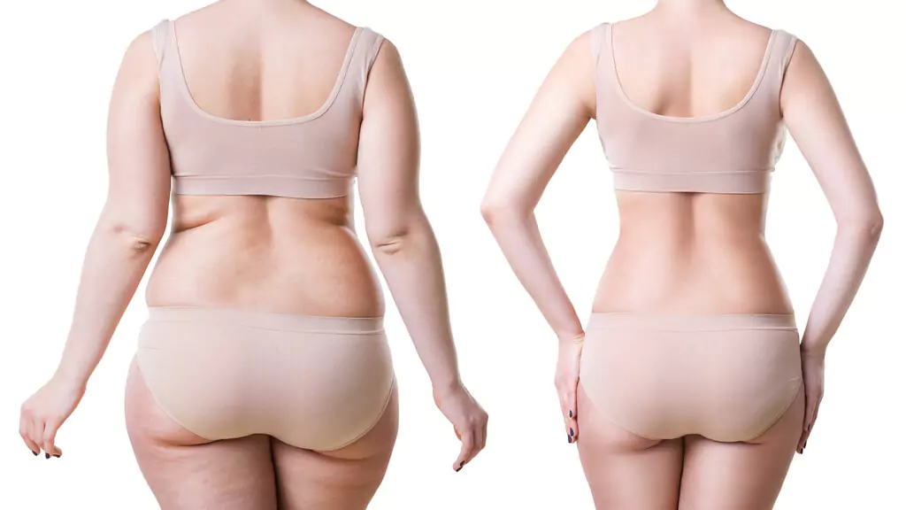 Liposuctie