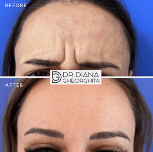 Riduri tratate cu acid hialuronic - înainte și după